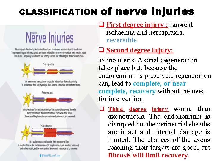 CLASSIFICATION of nerve injuries q First degree injury : transient ischaemia and neurapraxia, reversible.