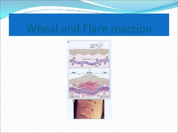 Wheal and Flare reaction 