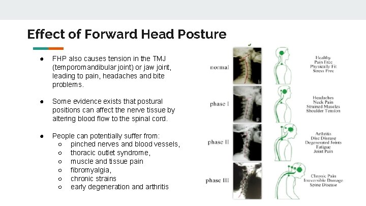 Effect of Forward Head Posture ● FHP also causes tension in the TMJ (temporomandibular