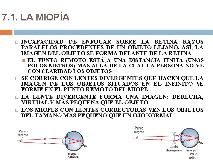 7. 1. LA MIOPÍA � INCAPACIDAD DE ENFOCAR SOBRE LA RETINA RAYOS PARALELOS PROCEDENTES