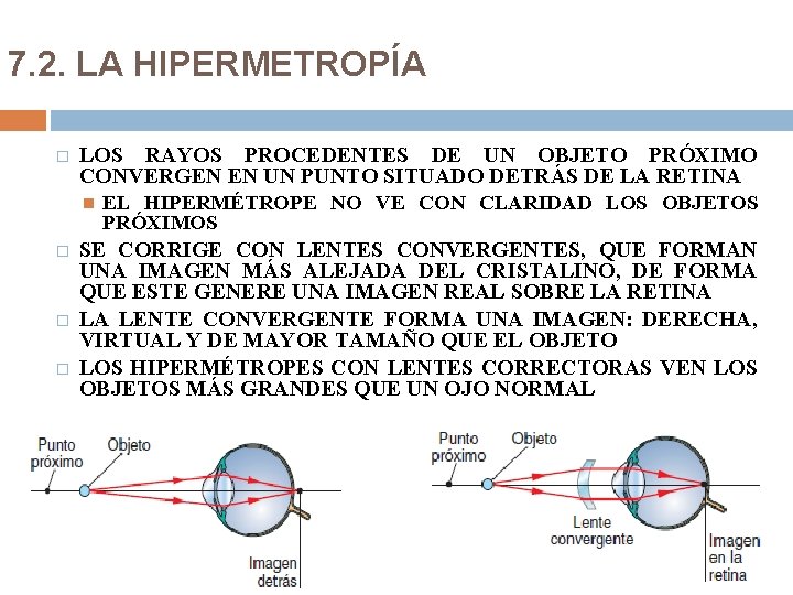 7. 2. LA HIPERMETROPÍA � LOS RAYOS PROCEDENTES DE UN OBJETO PRÓXIMO CONVERGEN EN