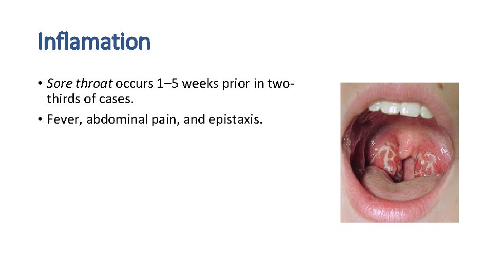 Inflamation • Sore throat occurs 1– 5 weeks prior in twothirds of cases. •