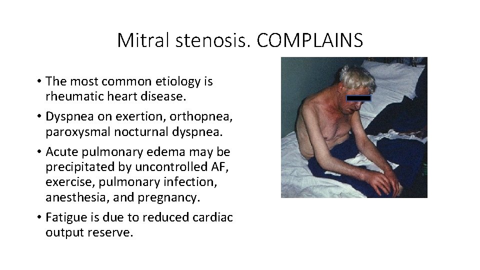Mitral stenosis. COMPLAINS • The most common etiology is rheumatic heart disease. • Dyspnea