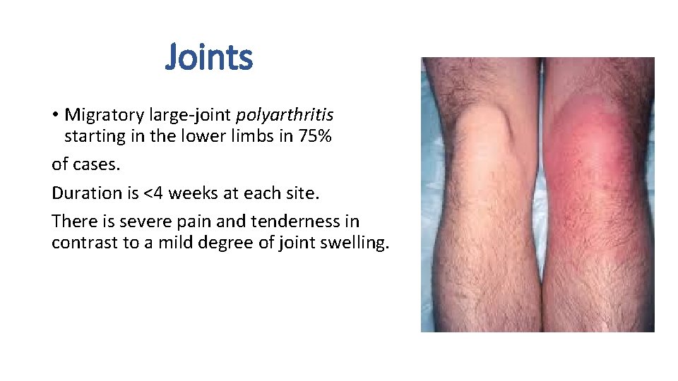 Joints • Migratory large-joint polyarthritis starting in the lower limbs in 75% of cases.