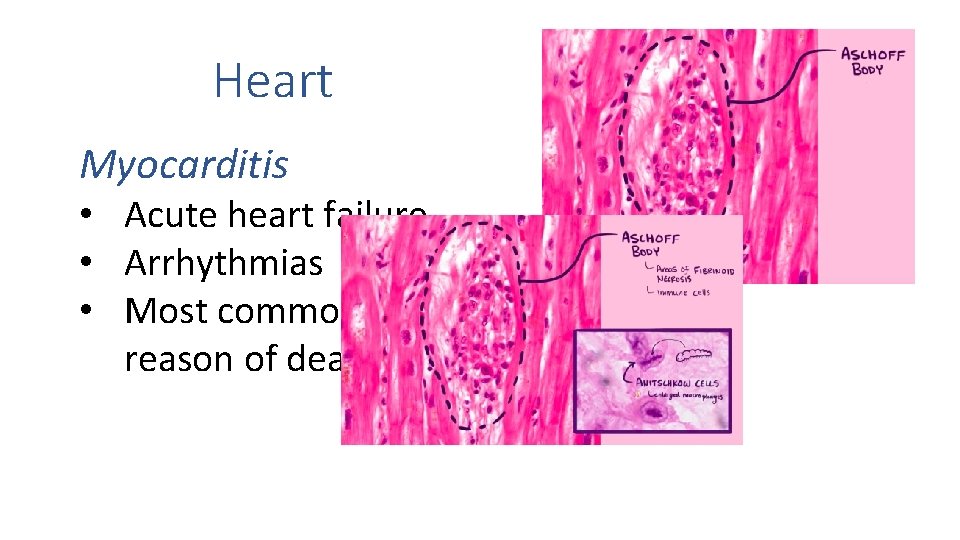 Heart Myocarditis • Acute heart failure • Arrhythmias • Most common reason of death