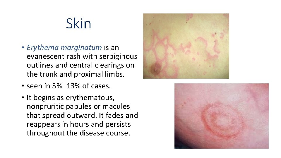 Skin • Erythema marginatum is an evanescent rash with serpiginous outlines and central clearings