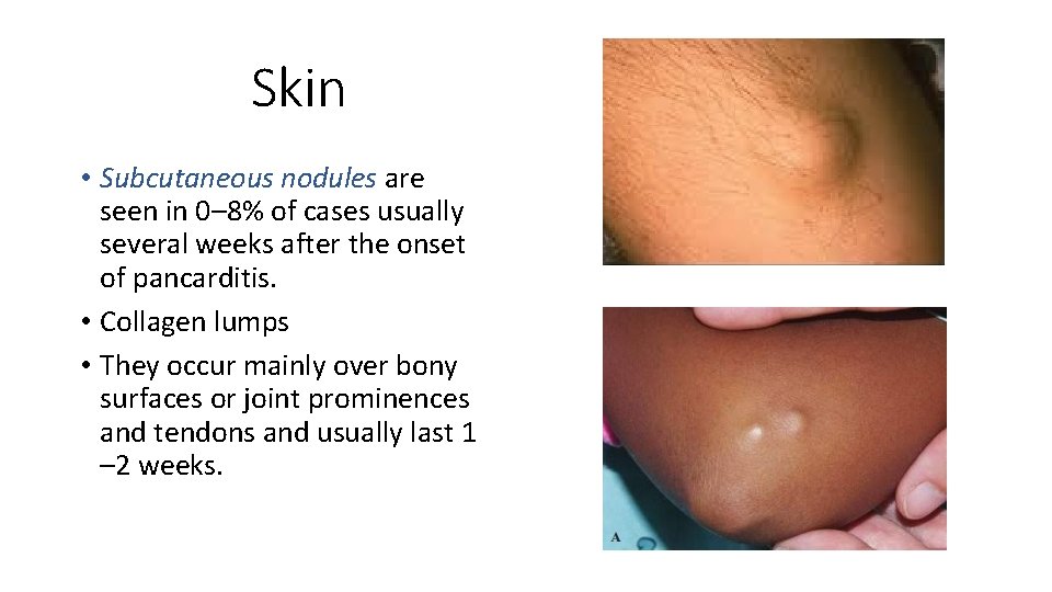 Skin • Subcutaneous nodules are seen in 0– 8% of cases usually several weeks