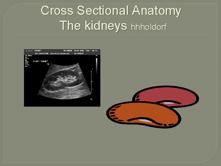 Cross Sectional Anatomy The kidneys hhholdorf 