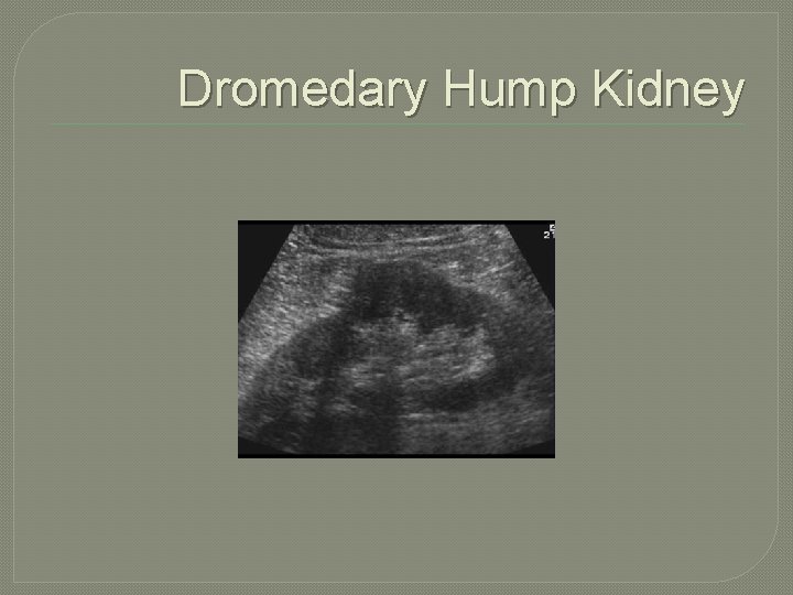 Dromedary Hump Kidney 