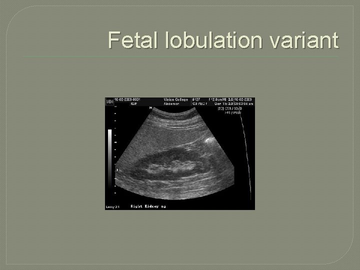 Fetal lobulation variant 