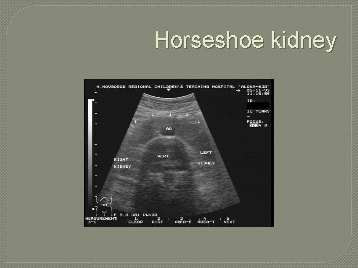 Horseshoe kidney 