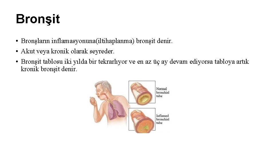 Bronşit • Bronşların inflamasyonuna(iltihaplanma) bronşit denir. • Akut veya kronik olarak seyreder. • Bronşit