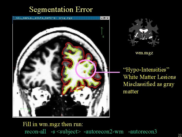 Segmentation Error wm. mgz “Hypo-Intensities” White Matter Lesions Misclassified as gray matter Fill in
