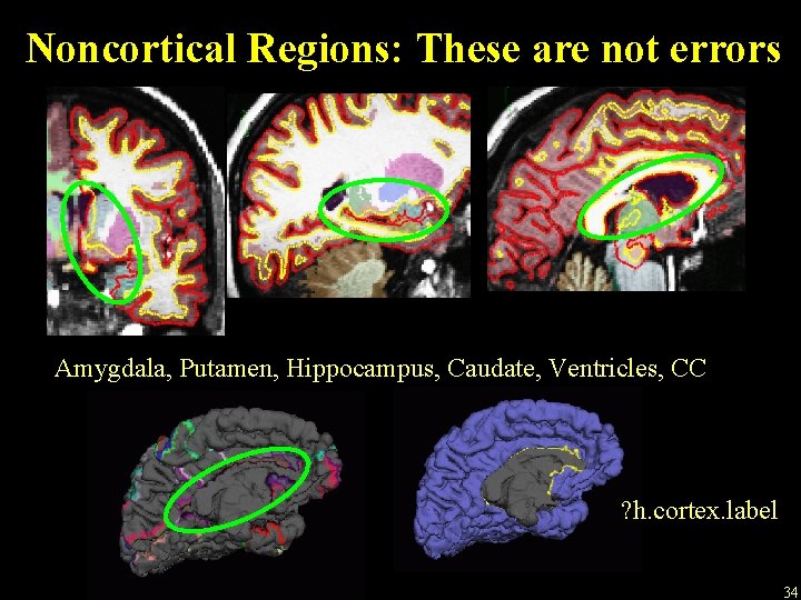 Noncortical Regions: These are not errors Amygdala, Putamen, Hippocampus, Caudate, Ventricles, CC ? h.