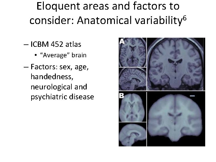 Eloquent areas and factors to consider: Anatomical variability 6 – ICBM 452 atlas •