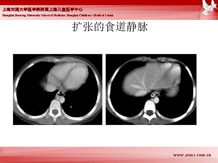 上海交通大学医学院附属上海儿童医学中心 Shanghai Jiaotong University School of Medicine Shanghai Children`s Medical Center 扩张的食道静脉 www. scmc.