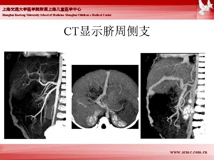 上海交通大学医学院附属上海儿童医学中心 Shanghai Jiaotong University School of Medicine Shanghai Children`s Medical Center CT显示脐周侧支 www. scmc.