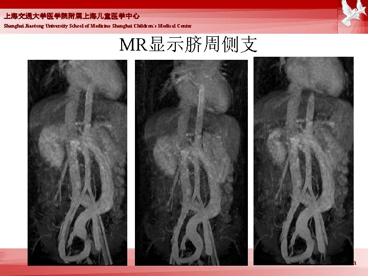 上海交通大学医学院附属上海儿童医学中心 Shanghai Jiaotong University School of Medicine Shanghai Children`s Medical Center MR显示脐周侧支 www. scmc.