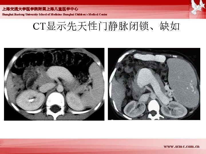 上海交通大学医学院附属上海儿童医学中心 Shanghai Jiaotong University School of Medicine Shanghai Children`s Medical Center CT显示先天性门静脉闭锁、缺如 www. scmc.