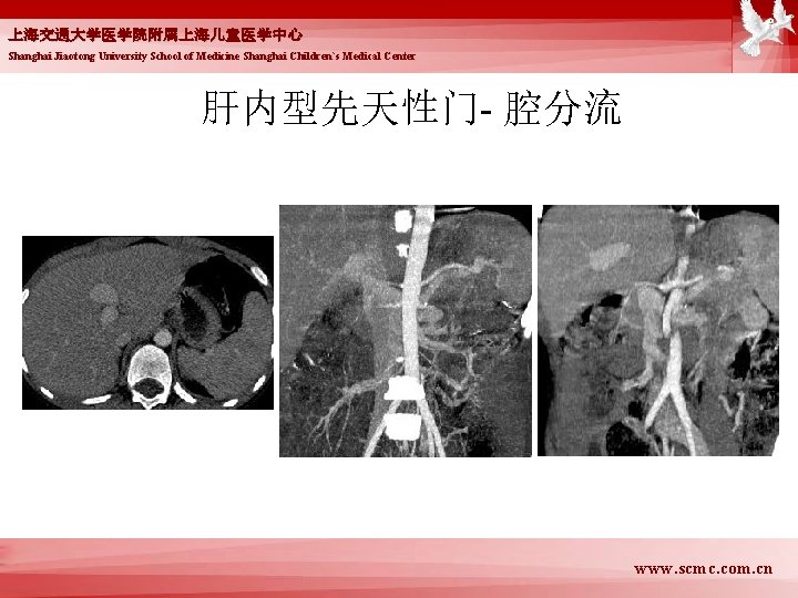 上海交通大学医学院附属上海儿童医学中心 Shanghai Jiaotong University School of Medicine Shanghai Children`s Medical Center 肝内型先天性门- 腔分流 www.