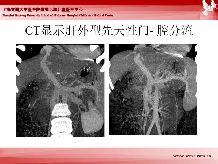 上海交通大学医学院附属上海儿童医学中心 Shanghai Jiaotong University School of Medicine Shanghai Children`s Medical Center CT显示肝外型先天性门- 腔分流 www.