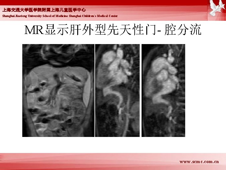 上海交通大学医学院附属上海儿童医学中心 Shanghai Jiaotong University School of Medicine Shanghai Children`s Medical Center MR显示肝外型先天性门- 腔分流 www.