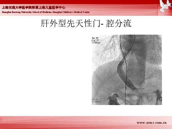 上海交通大学医学院附属上海儿童医学中心 Shanghai Jiaotong University School of Medicine Shanghai Children`s Medical Center 肝外型先天性门- 腔分流 www.