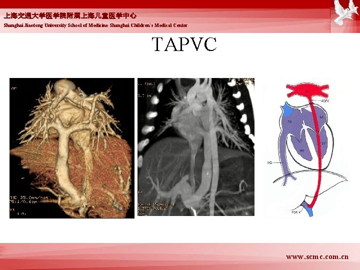 上海交通大学医学院附属上海儿童医学中心 Shanghai Jiaotong University School of Medicine Shanghai Children`s Medical Center TAPVC www. scmc.