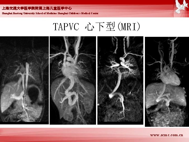 上海交通大学医学院附属上海儿童医学中心 Shanghai Jiaotong University School of Medicine Shanghai Children`s Medical Center TAPVC 心下型(MRI) www.