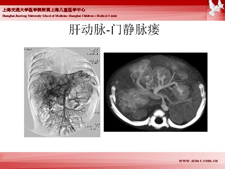 上海交通大学医学院附属上海儿童医学中心 Shanghai Jiaotong University School of Medicine Shanghai Children`s Medical Center 肝动脉-门静脉瘘 www. scmc.