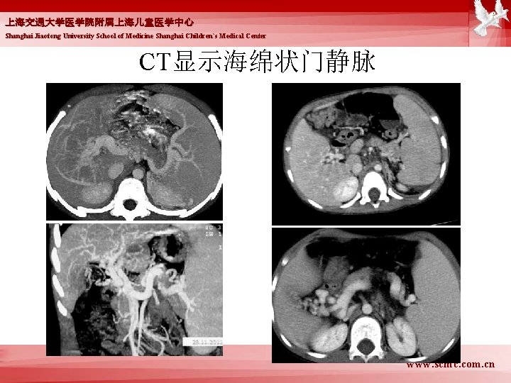 上海交通大学医学院附属上海儿童医学中心 Shanghai Jiaotong University School of Medicine Shanghai Children`s Medical Center CT显示海绵状门静脉 www. scmc.