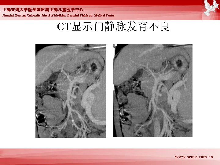 上海交通大学医学院附属上海儿童医学中心 Shanghai Jiaotong University School of Medicine Shanghai Children`s Medical Center CT显示门静脉发育不良 www. scmc.