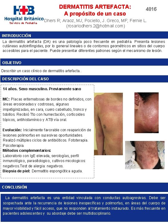 DERMATITIS ARTEFACTA: A propósito de un caso Servicio de Pediatría 4816 Dhers R; Araoz,