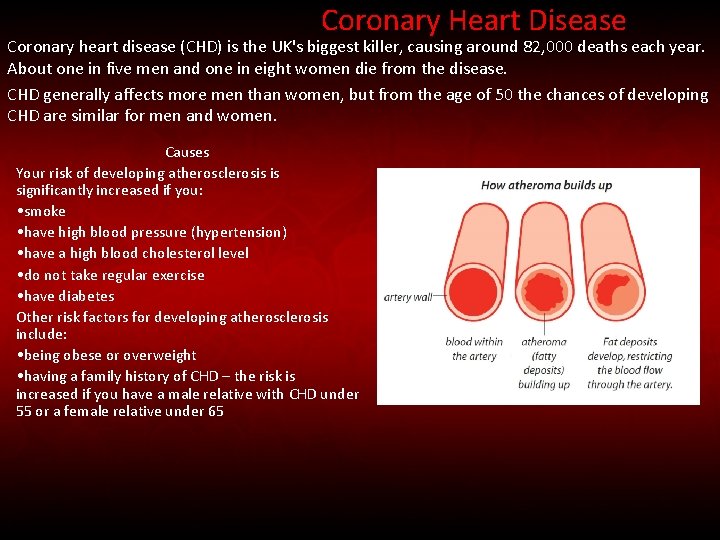 Coronary Heart Disease Coronary heart disease (CHD) is the UK's biggest killer, causing around