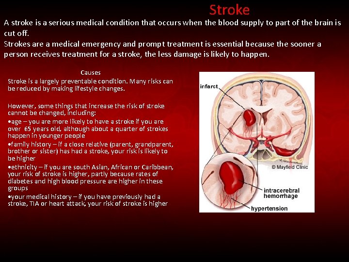 Stroke A stroke is a serious medical condition that occurs when the blood supply