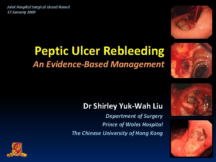 Joint Hospital Surgical Grand Round 17 January 2009 Peptic Ulcer Rebleeding An Evidence-Based Management