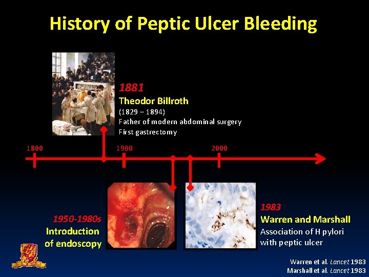 History of Peptic Ulcer Bleeding 1881 Theodor Billroth (1829 – 1894) Father of modern