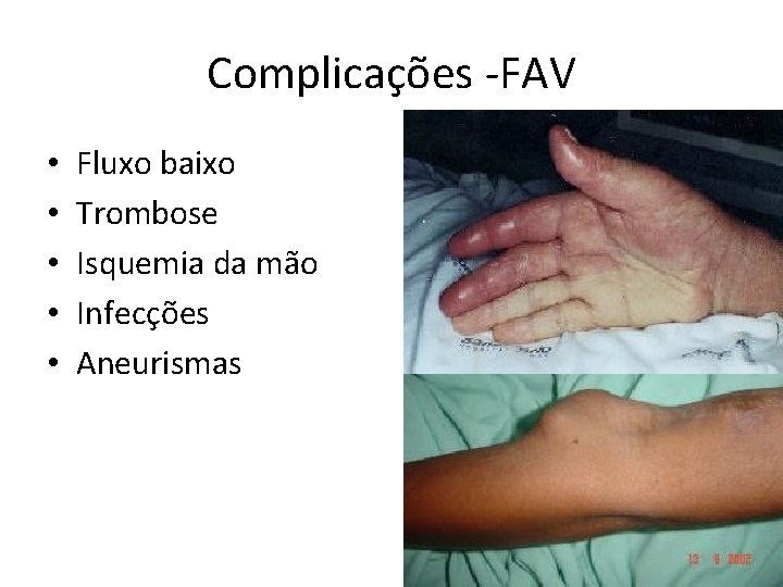 Complicações FAV • • • Fluxo baixo Trombose Isquemia da mão Infecções Aneurismas 