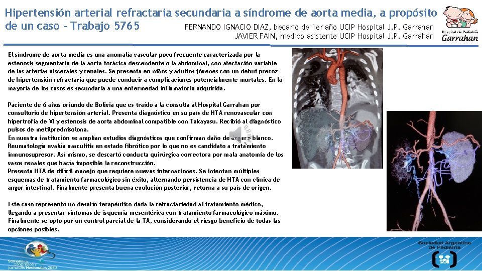 Hipertensión arterial refractaria secundaria a síndrome de aorta media, a propósito de un caso