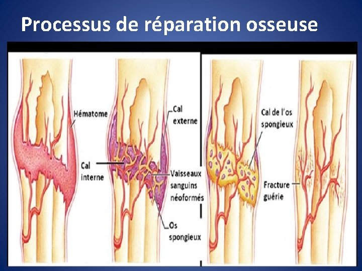 Processus de réparation osseuse 