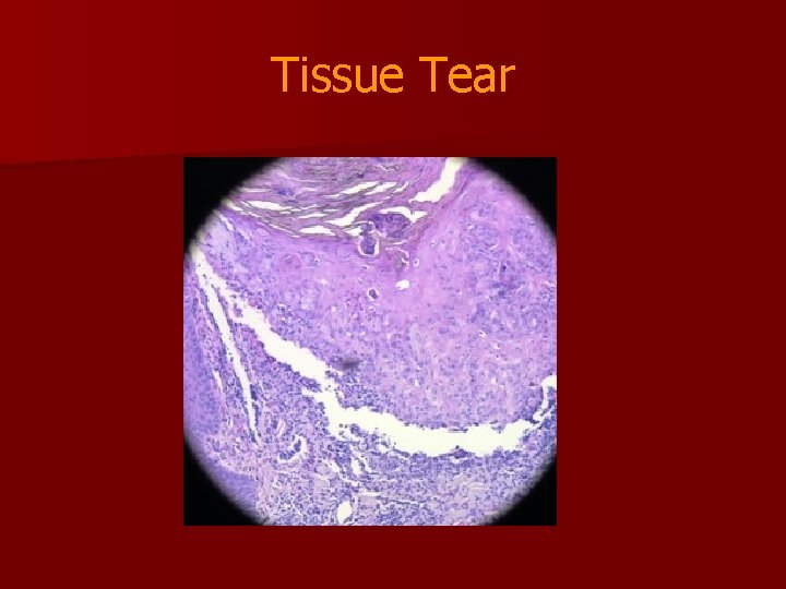 Tissue Tear 