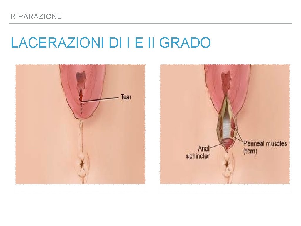 RIPARAZIONE LACERAZIONI DI I E II GRADO 