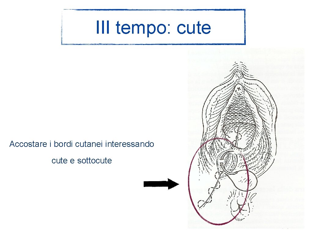 III tempo: cute Accostare i bordi cutanei interessando cute e sottocute 