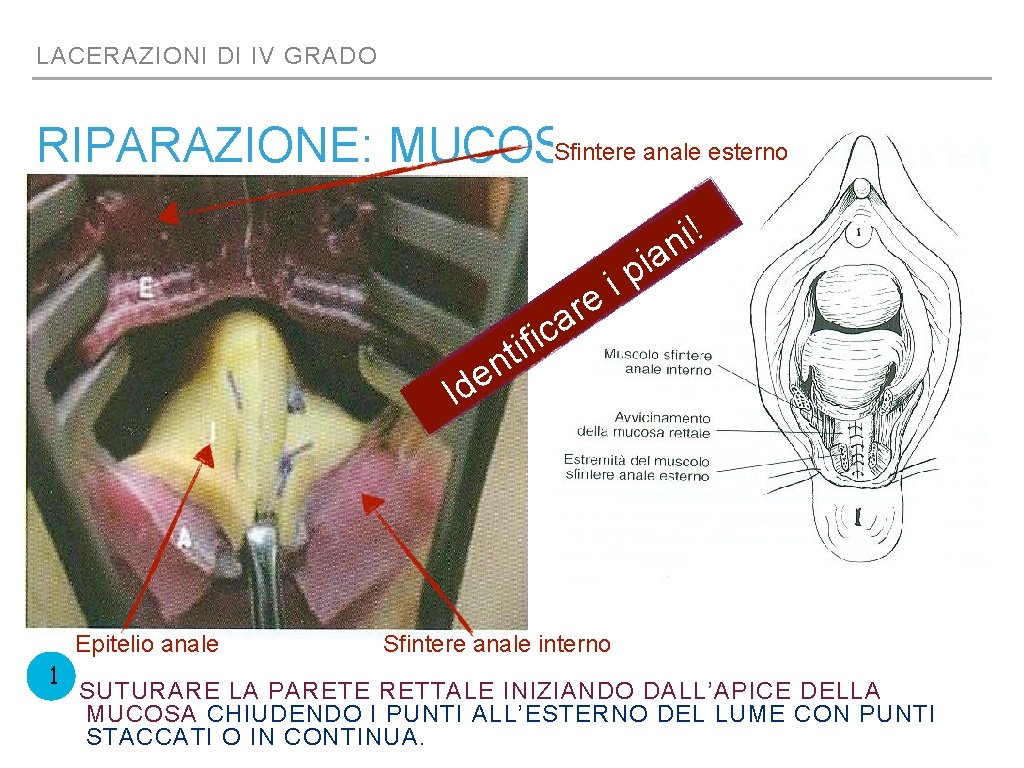 LACERAZIONI DI IV GRADO Sfintere anale esterno RIPARAZIONE: MUCOSA r a ic f i