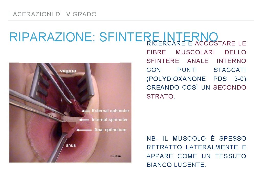 LACERAZIONI DI IV GRADO RIPARAZIONE: SFINTERE INTERNO RICERCARE E ACCOSTARE LE FIBRE MUSCOLARI DELLO