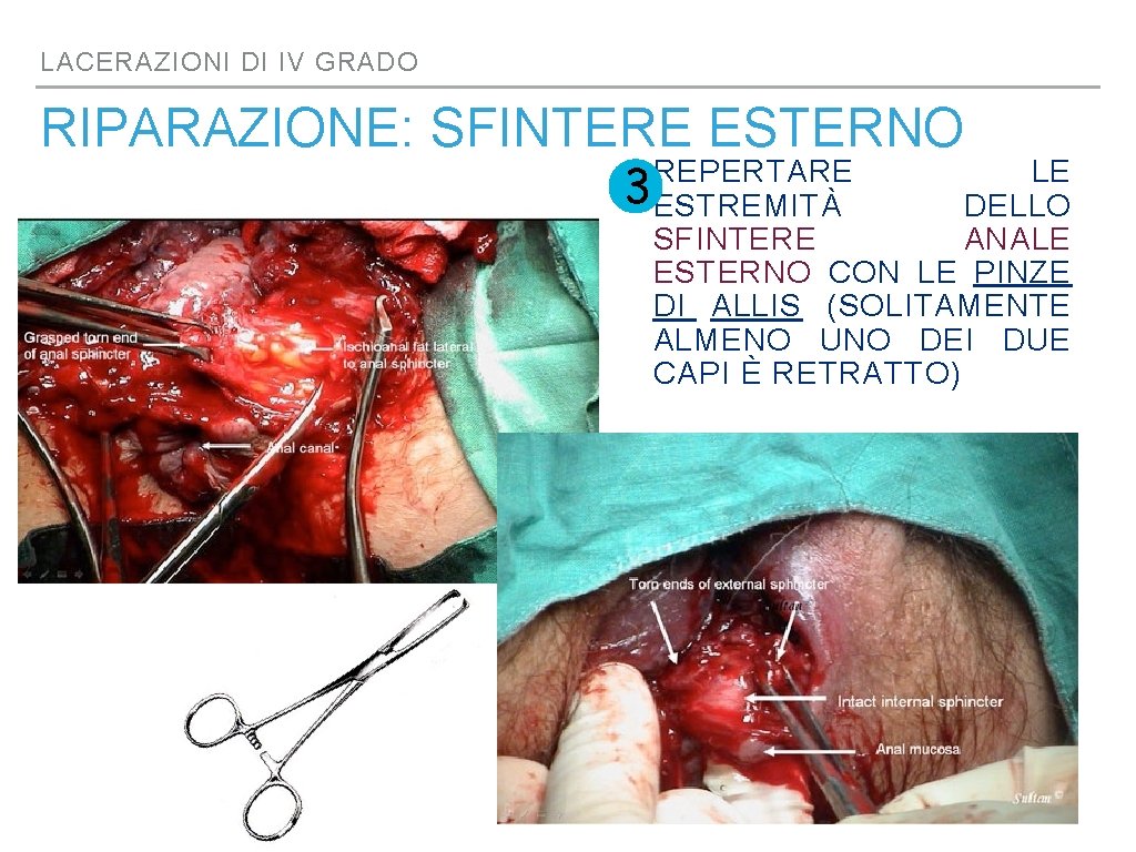 LACERAZIONI DI IV GRADO RIPARAZIONE: SFINTERE ESTERNO REPERTARE LE 3 ESTREMITÀ DELLO SFINTERE ANALE