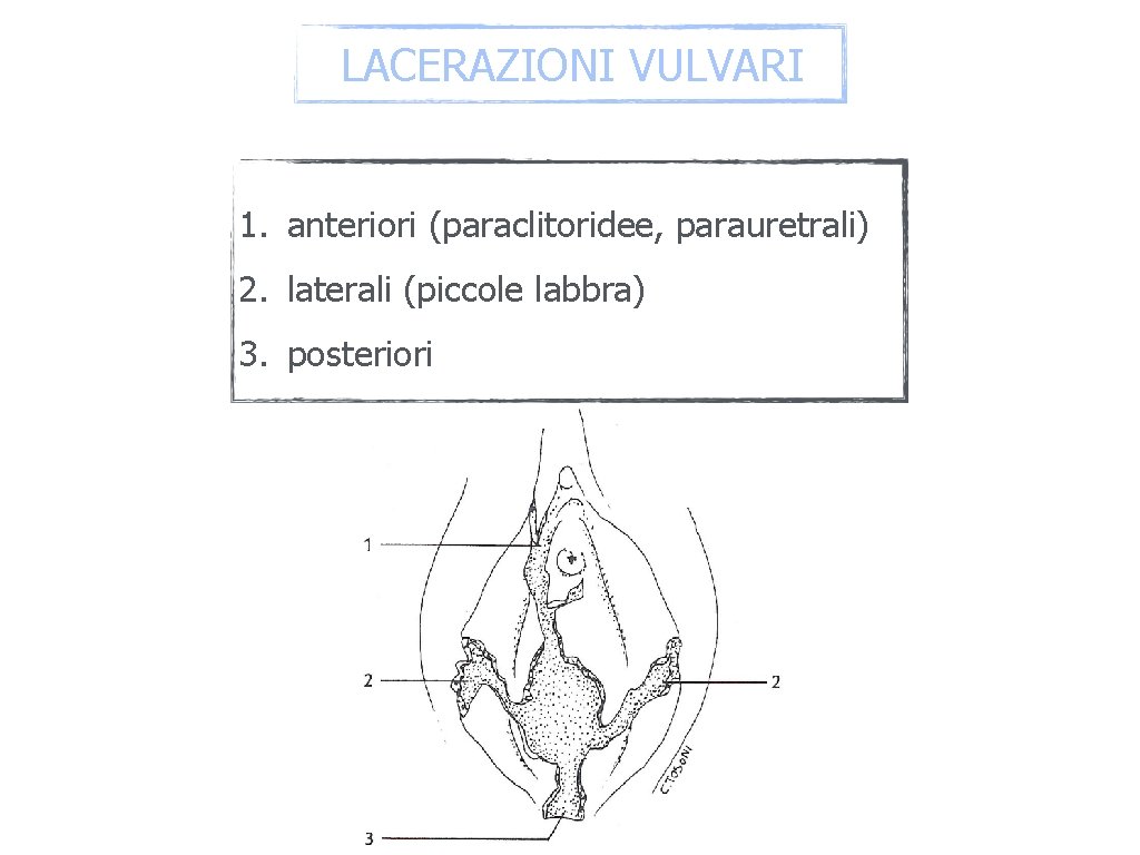 LACERAZIONI VULVARI 1. anteriori (paraclitoridee, parauretrali) 2. laterali (piccole labbra) 3. posteriori 