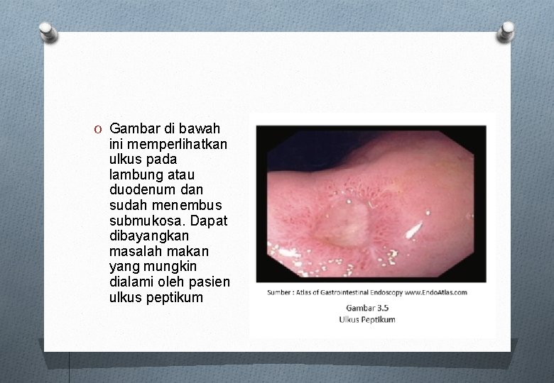 O Gambar di bawah ini memperlihatkan ulkus pada lambung atau duodenum dan sudah menembus O Gambar di bawah ini memperlihatkan ulkus pada lambung atau duodenum dan sudah menembus