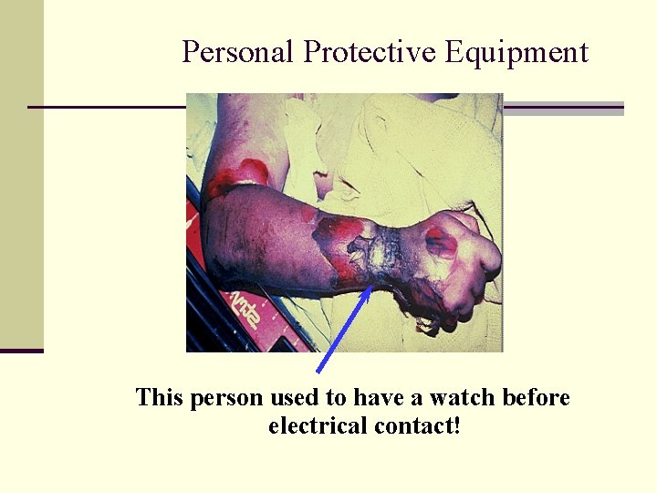 Personal Protective Equipment This person used to have a watch before electrical contact! 