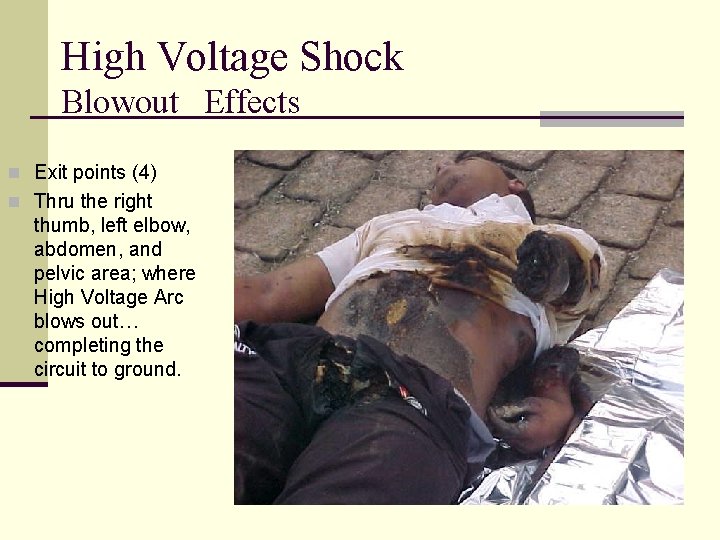 High Voltage Shock Blowout Effects n Exit points (4) n Thru the right thumb,